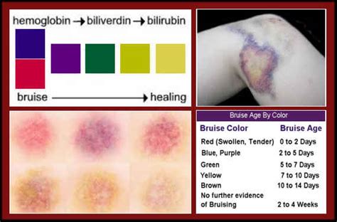 Bruise Color Chart