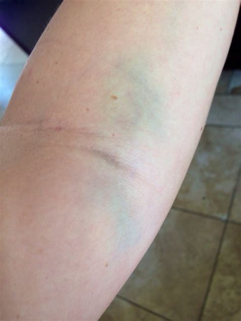 Bruise From Blood Draw 2 Weeks