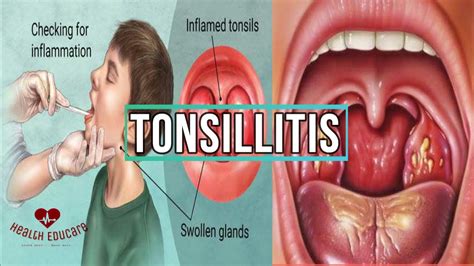 Bruising Or Discoloration And Spots On Tonsils - MedicineNet