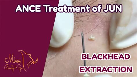 WELCOME TO MY CHANNELhow to skincarepopping big pimplescystic acne removal close updilated pore of winer pimple popper blackhead on facewhiteheads around nos.... 