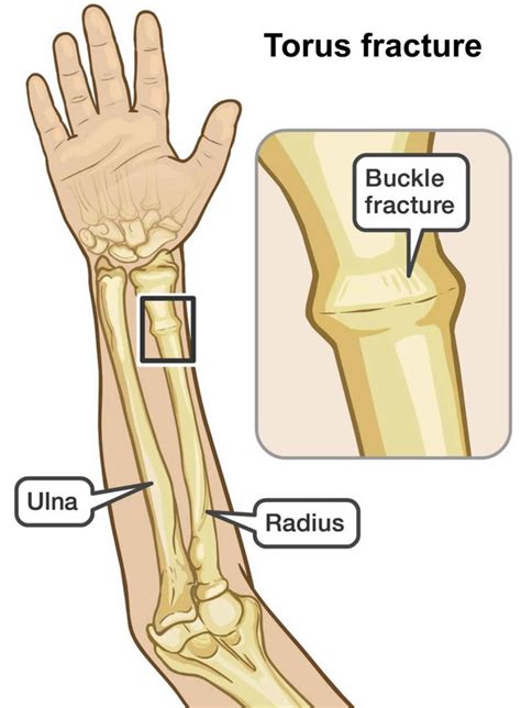 Buckled, bent or broken? - Royal Australian College of General ...