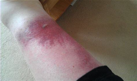Bug bite turned purple after a few days. How to tell if your bee sting is infected. It will start to look and feel worse. “You can get redness and swelling,” Dr. Wright explains. “It can also feel warm or tender to touch, and if ... 