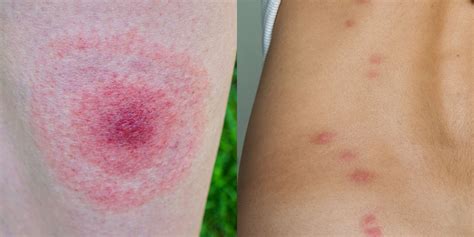 Bug bites that turn purple. Recluse spider bites. Signs and symptoms of a recluse spider bite can include: Increasing pain over the first eight hours after the bite; Fever, chills and body … 