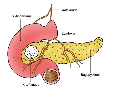 Bugspytkirtlen kræft