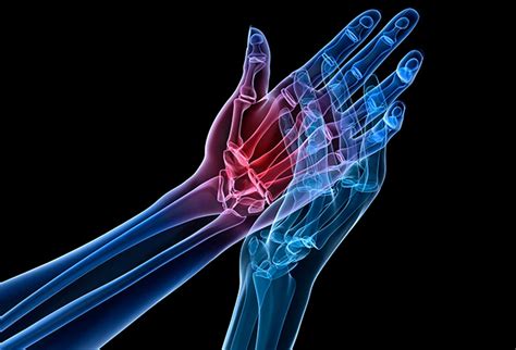 Bump on Finger and Hand SPORT Orthopedics Dallas