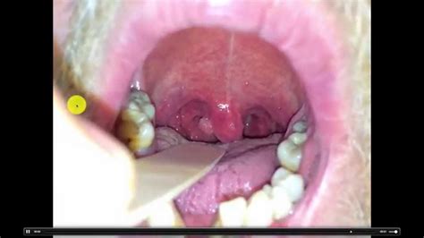 Throat cancers are usually found in the oropharynx, which includes the tonsils, the uvula (the small structure dangling in the middle), the soft palate, and the hind-most portion of the tongue, which is not visible without a scope. But they can also develop in the larynx and the nasopharynx (the area behind the nose).. 