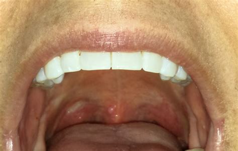 Bumps by uvula. Signs and symptoms of soft palate cancer can include the following: Bleeding in the mouth. Difficulty swallowing. Difficulty speaking. Bad breath. Mouth pain. Sores in the mouth that won't heal. Loose teeth. Pain when swallowing. 