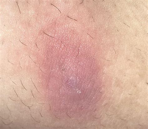 Bumps on inner thigh. Jock itch affects the skin of the inner thigh, buttocks, and genital area. ... Symptoms of swimmer’s itch can include sensations of itching or burning as well as small red bumps or blisters. It ... 