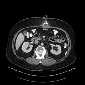 Buried bumper syndrome Radiology Reference Article