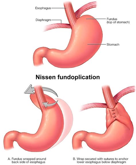 Burping after nissen fundoplication.  They&rsquo;ll also explain what to expect the day of your ...