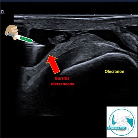 Bursitis olecraneana – Resección quirúrgica – Cirujano Hombro