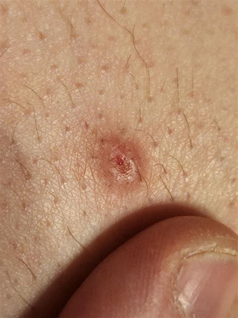 Burst cyst in bikini line : r/WomensHealth - Reddit