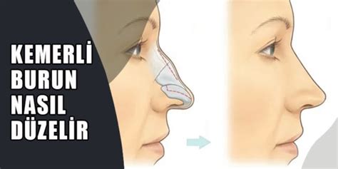 Burun ameliyatı.