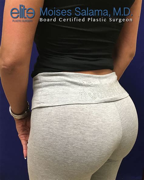 Butt Implants in South Africa • Check Prices & Reviews