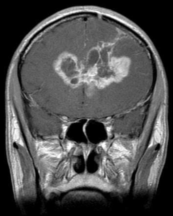 Butterfly glioma Radiology Case Radiopaedia.org