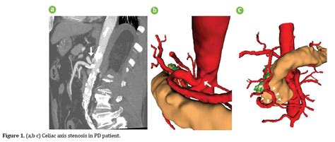 C liac Axis Stenosis