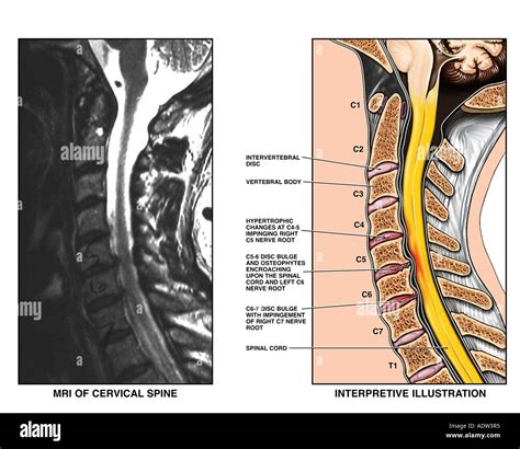 C3-4, C4-5 and C5-6 Cervical Spine Injuries : Medical Chart