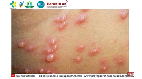 cacar di tenggorokan - elchoricharrua.com