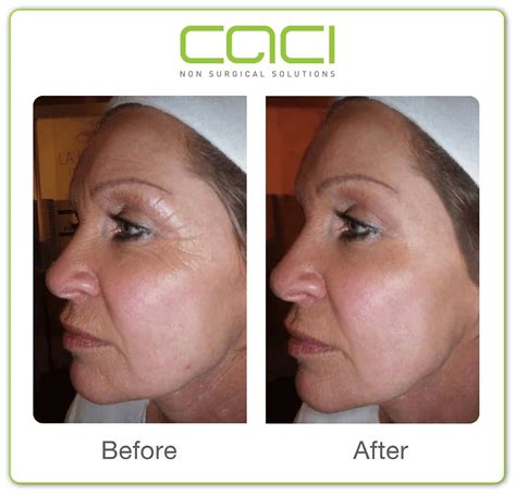 CACI Facial: Non-Surgical Facelift Review - Bellatory