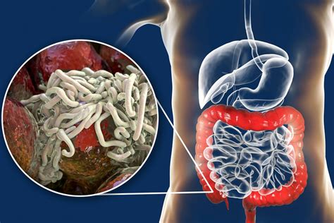 cacing di perut manusia - elchoricharrua.com