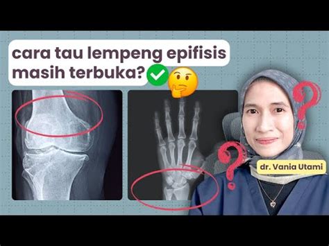 cara mengetahui lempeng epifisis masih terbuka - wethersfieldchildhood.com