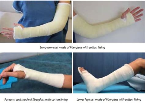 Care of Casts and Splints - OrthoInfo - AAOS - muktibox.com