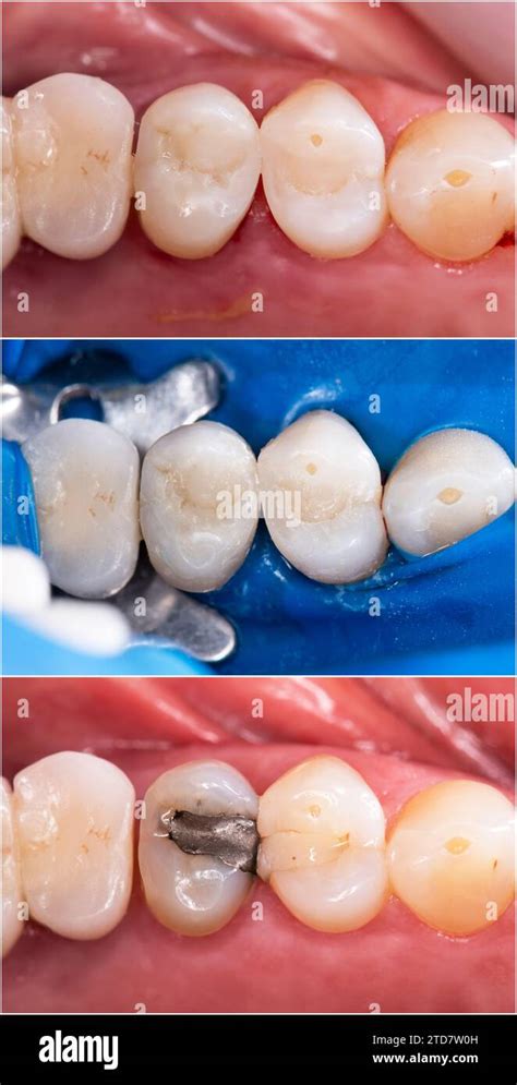 Ceramic Restoration | Premier Ceramic Restoration Services - muktibox.com