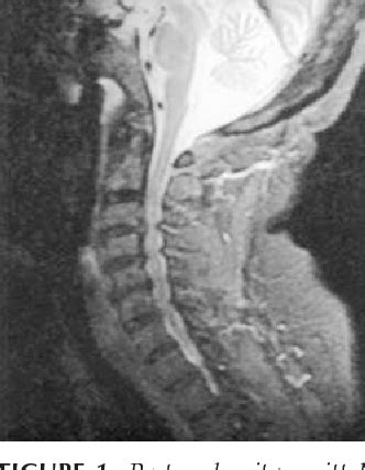 CERVICAL SPONDYLOTIC MYELOPATHY: A BRIEF REVIEW OF ITS PATHOPHYSIOLOGY …