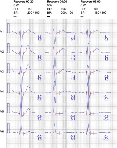 CHANGES TO EKG TREADMILL/ STRESS TEST RESULTS DISPLAY …