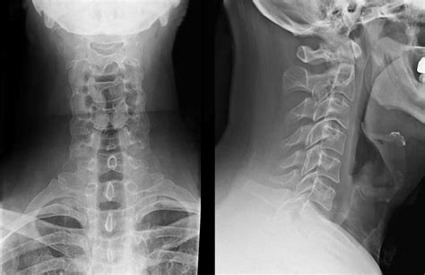 CHAPTER 4: CERVICAL SPINE TRAUMA - Chiro