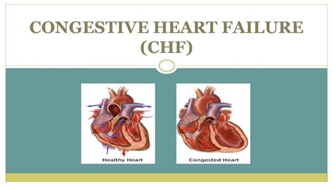 CHF (Congestive Heart Failure) Adalah? - HonestDocs