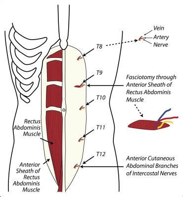 CHRONIC ABDOMINAL WALL PAIN: A MISSED …