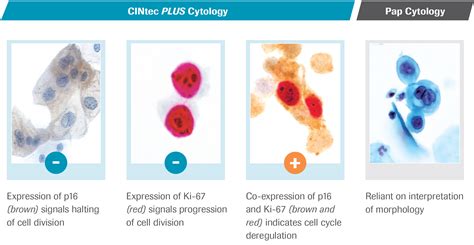 CINtec® PLUS IMMUNOCYTOCHEMICAL ASSAY - force.com