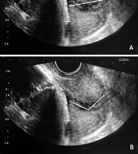 CL measurement in a curved cervix. The cervix can be measured in a