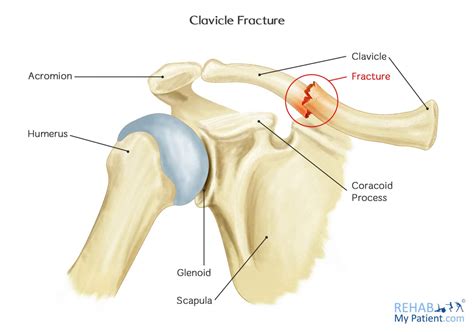 Clavicle fracture - wintechmobiles.com