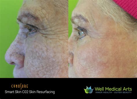 CO2 Resurfacing Luxe Laser Center