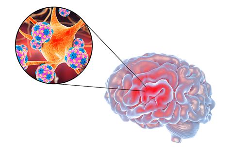 COMMON VIRUSES LEADING TO RECURRENT ENCEPHALITIS