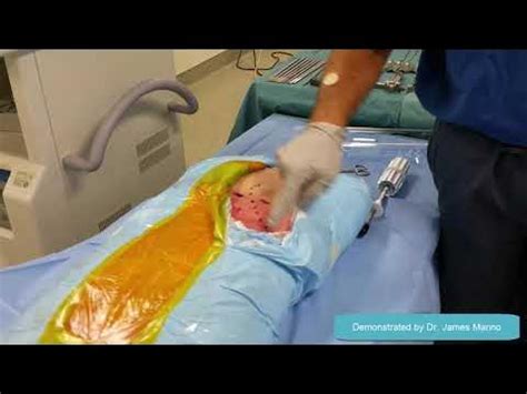 COREX™ Posterior Iliac Crest (ICBG) - YouTube