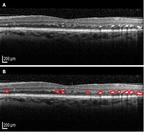 CORRELATION OF OPTICAL COHERENCE TOMOGRAPHIC HYPERREFLECTIVE FOCI ... - LWW