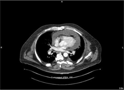 COVID-19 presenting as acute pericarditis BMJ Case Reports