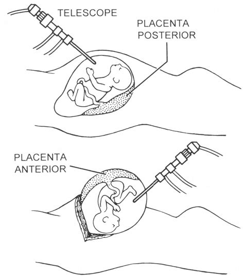 CP.MP.129 Fetal Surgery in Utero - Health Net