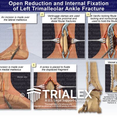 CPT® Code 27822 in section: Open treatment of trimalleolar …