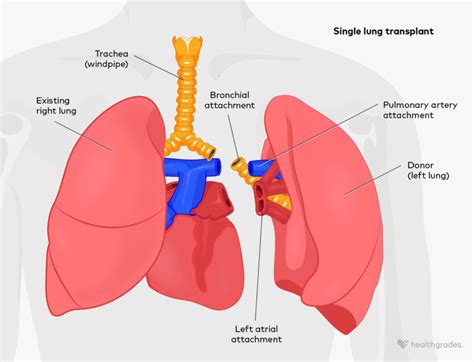 CPT® Code 32853 - Lung Transplantation Procedures