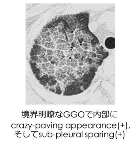 CTですりガラス陰影（GGO）のみで構成される小結節の診断と治療 …