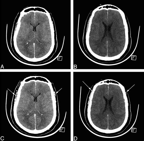 CT Angiography for Brain Death Diagnosis American Journal …