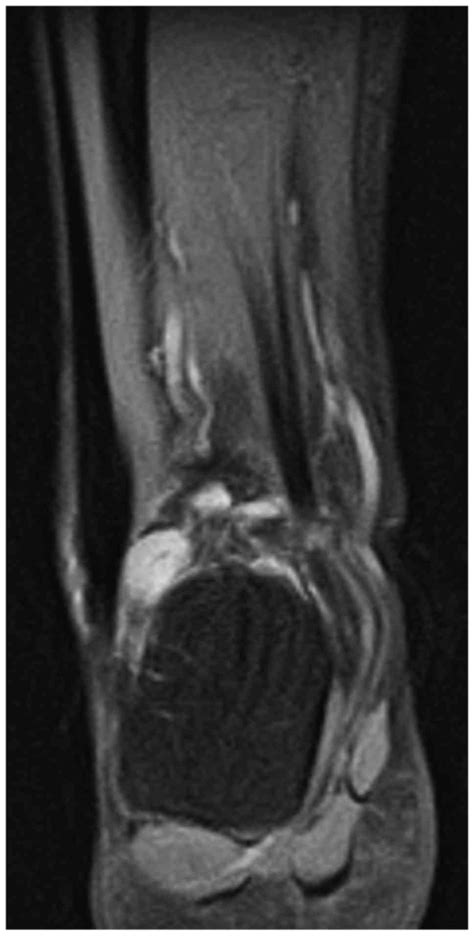 CT and MR imaging features in phosphaturic mesenchymal tumor …