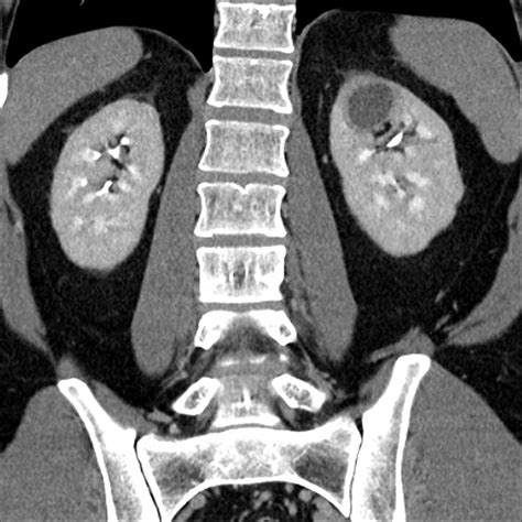 CT and MR imaging of cystic renal lesions - Insights into …