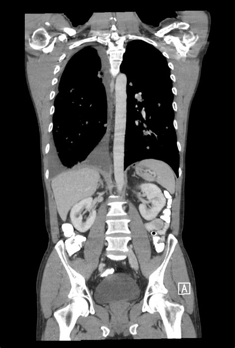 CT cerebral + torace + abdomen superior + abdomen inferior …