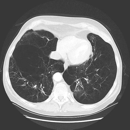 CT chest (summary) Radiology Referen…