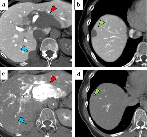 CT during hepatic arteriography and portography: an